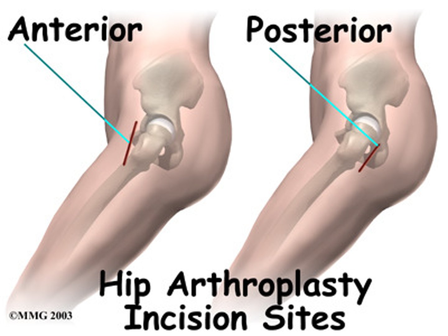 <p>Posterolateral</p>