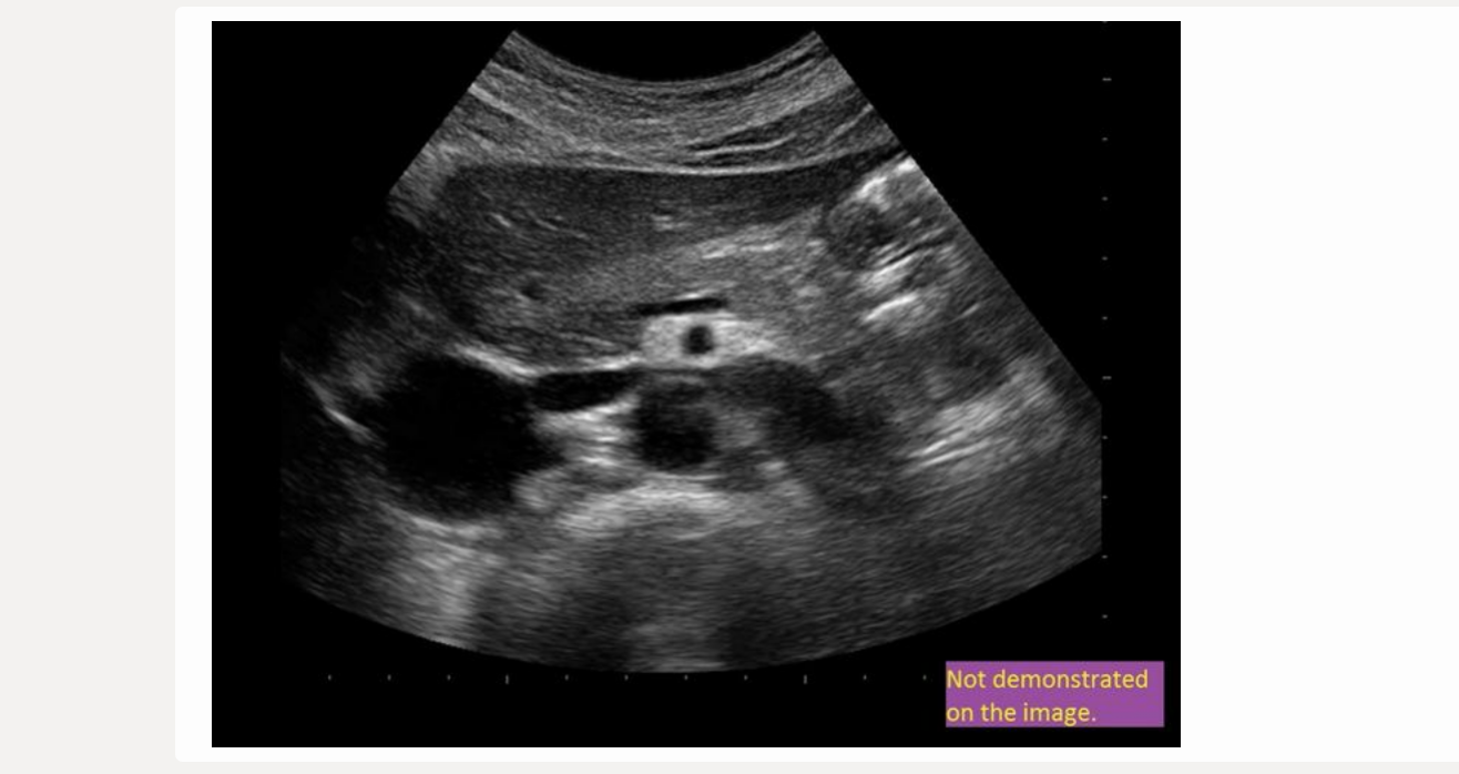 <p>find the right renal vein</p><p>.</p><p>[has to be on the IVC]</p>