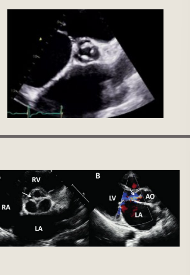 <p>Rheumatic AV includes symmetric</p><p>fibrosis, retraction and partial fusion of</p><p>the commissures of the cusps</p><p>May see doming during opening in PLAX</p><p>Associated aortic regurgitation, aortic</p><p>stenosis, and rheumatic mitral valve</p><p>disease</p>