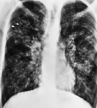 <p>Cystic fibrosis</p>