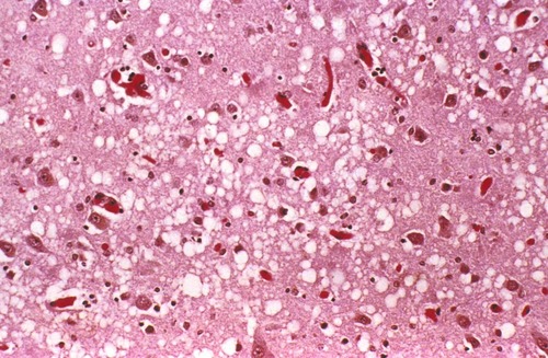 prion disease in humans that is caused by cannibalism, characterized by breakdown of tissue in brain