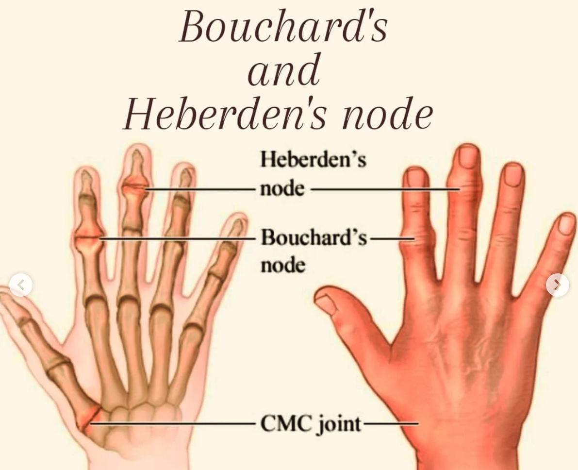 <p>-Degenerative joint disease caused by wear and tear, typically affects large weight bearing joints and hyaline cartilage</p><p>-Non-inflammatory (although there are periodic stages of local inflammation/decreased ROM)<br>- Can cause bone spurs at the PIP (Bouchard’s nodes) and DIP joint (Herbedon’s nodes) <span data-name="high_voltage" data-type="emoji">⚡</span>️Herb dip<br>-PROM Should be avoided at the inflammatory stage. Avoid muscle testing. <br><br>OT int: </p><ul><li><p>Resting hand splint in the acute stage, ulnar drift splint to prevent deformity, silver rings for swan neck and deformity and boutonniere deformity</p></li><li><p>Joint protection techniques, energy conservation techniques, all exercises should be pain free </p></li></ul><ul><li><p>Heat can help relieve stiffness/pain (paraffin), but avoid in inflammatory stage</p></li><li><p>Strengthening avoid in inflammatory stage, adaptive equipment to decrease stress on small joints</p></li></ul><p></p>