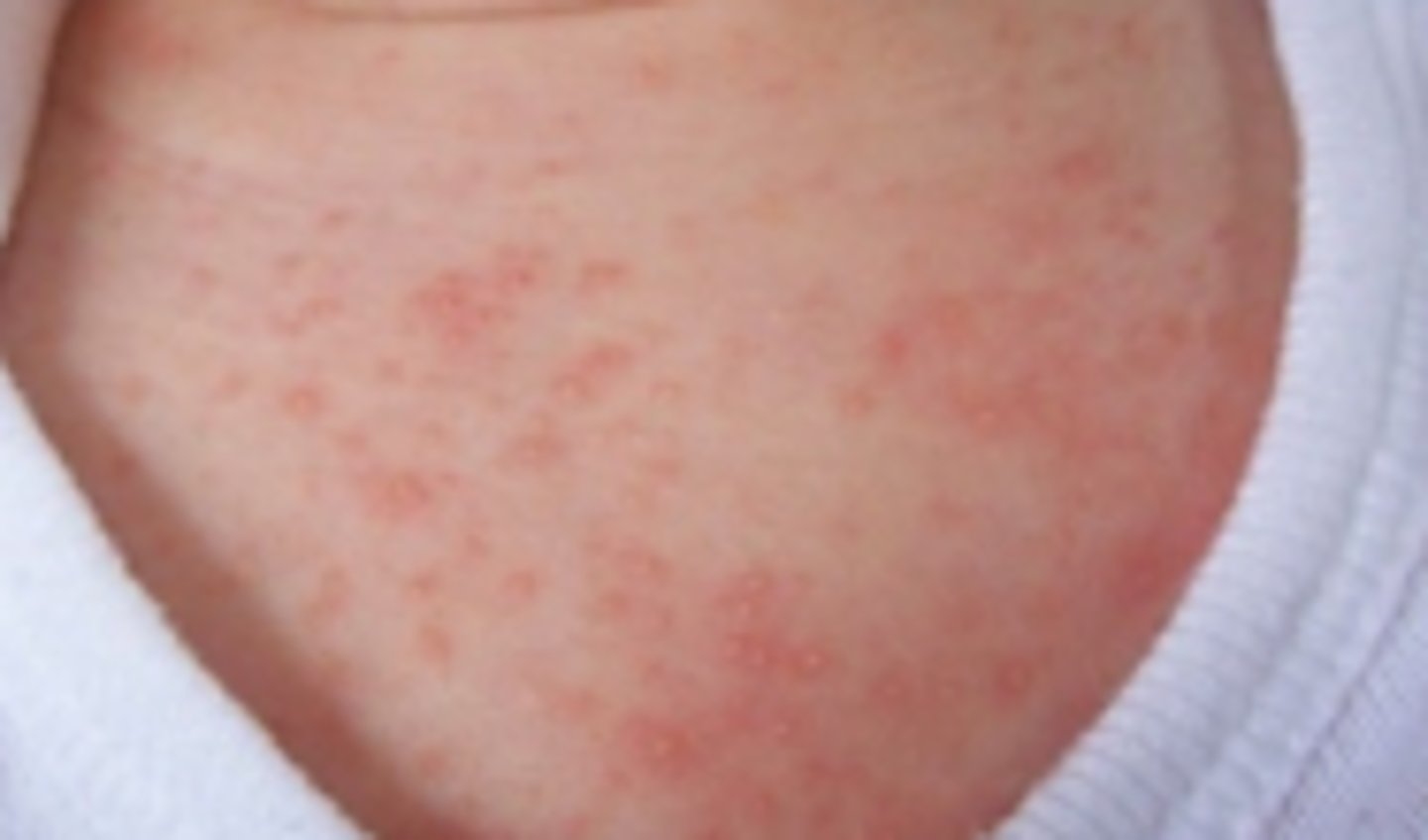 <p>red blotch w/ small white pimple</p><p>appears first days of life and resolves spontaneusly</p>