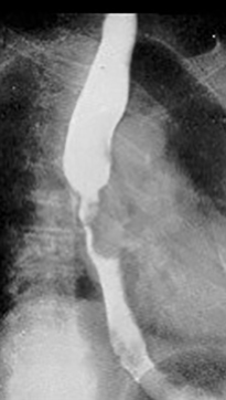 <p>What are the two growth patterns of esophageal carcinoma?</p>