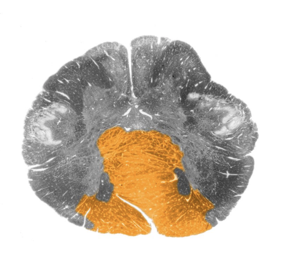 <p>Pyramidal decussation</p>