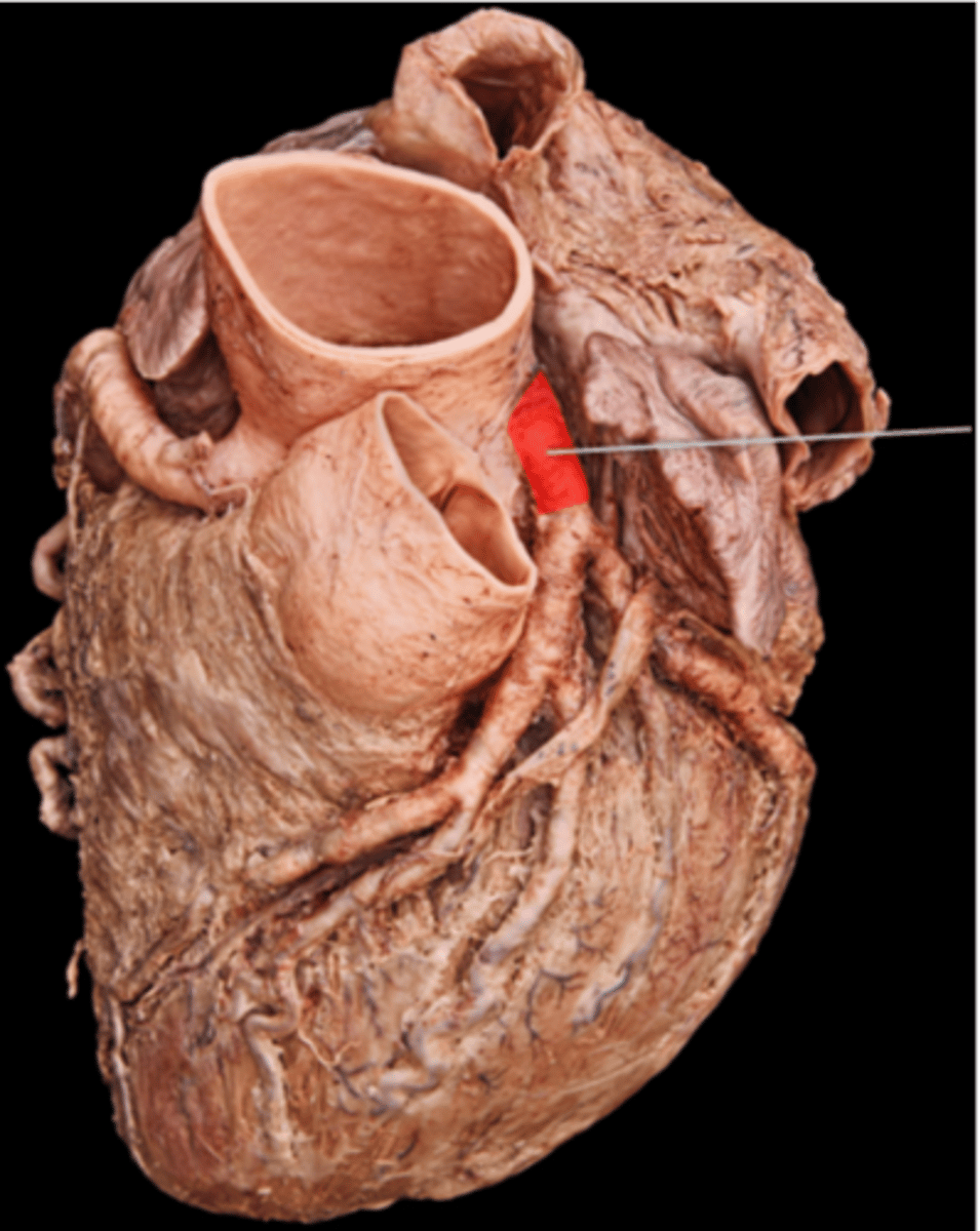 <p>Circumflex artery</p>