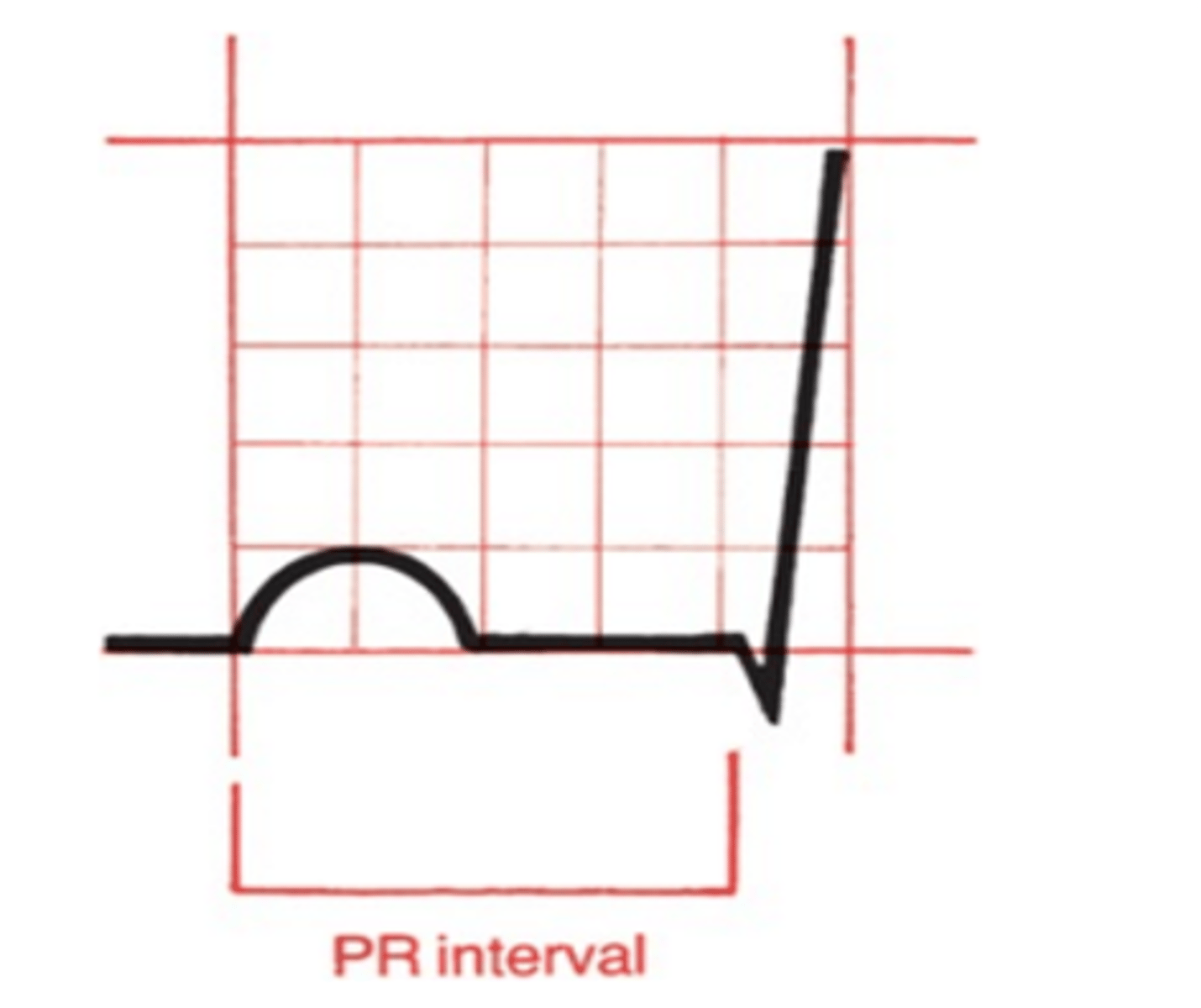 <p>Ventricular filling due to pause at AV node</p><p>Normal: 0.12-0.2 seconds (3-5 small boxes)</p>