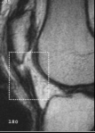 <p>Bovenaan peesontsteking (patella)</p>