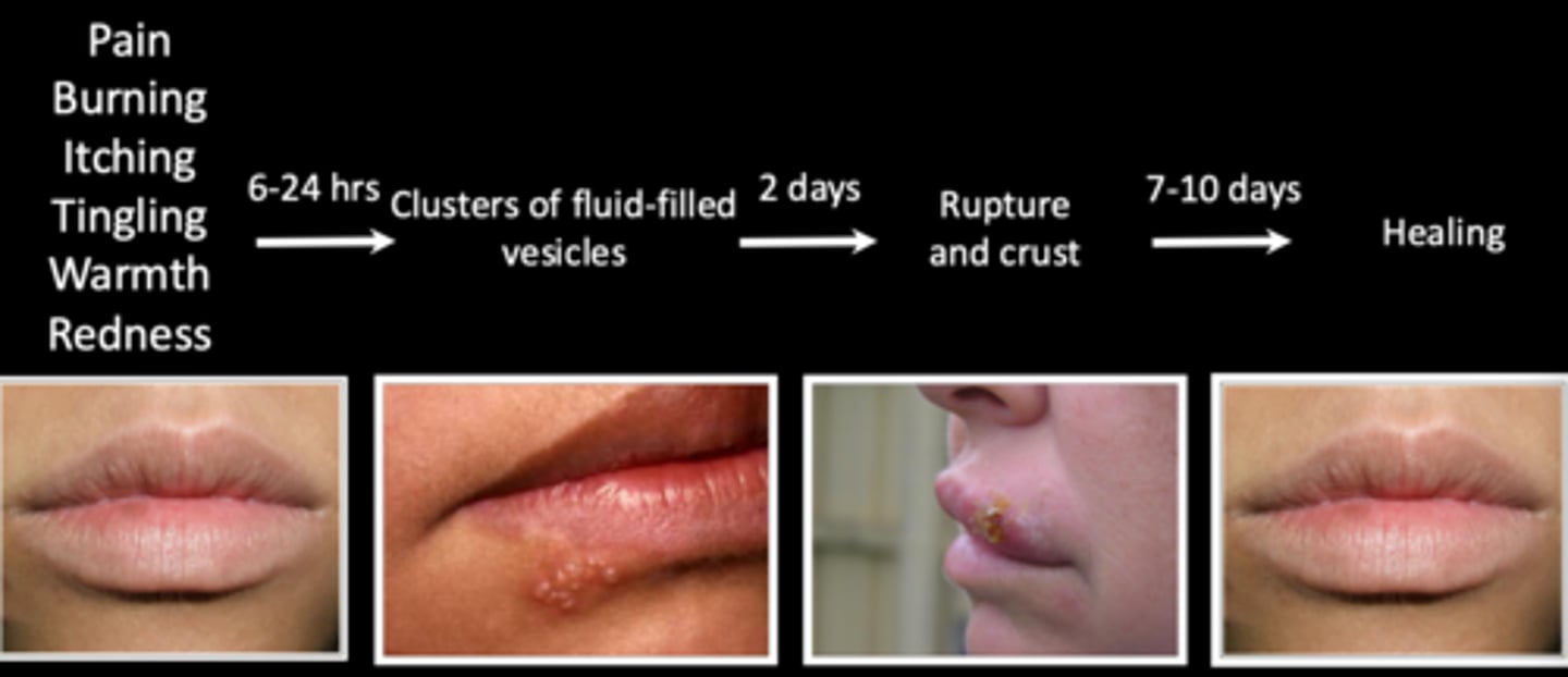 <p>recurrent; these are the prodrome of reactivation</p>