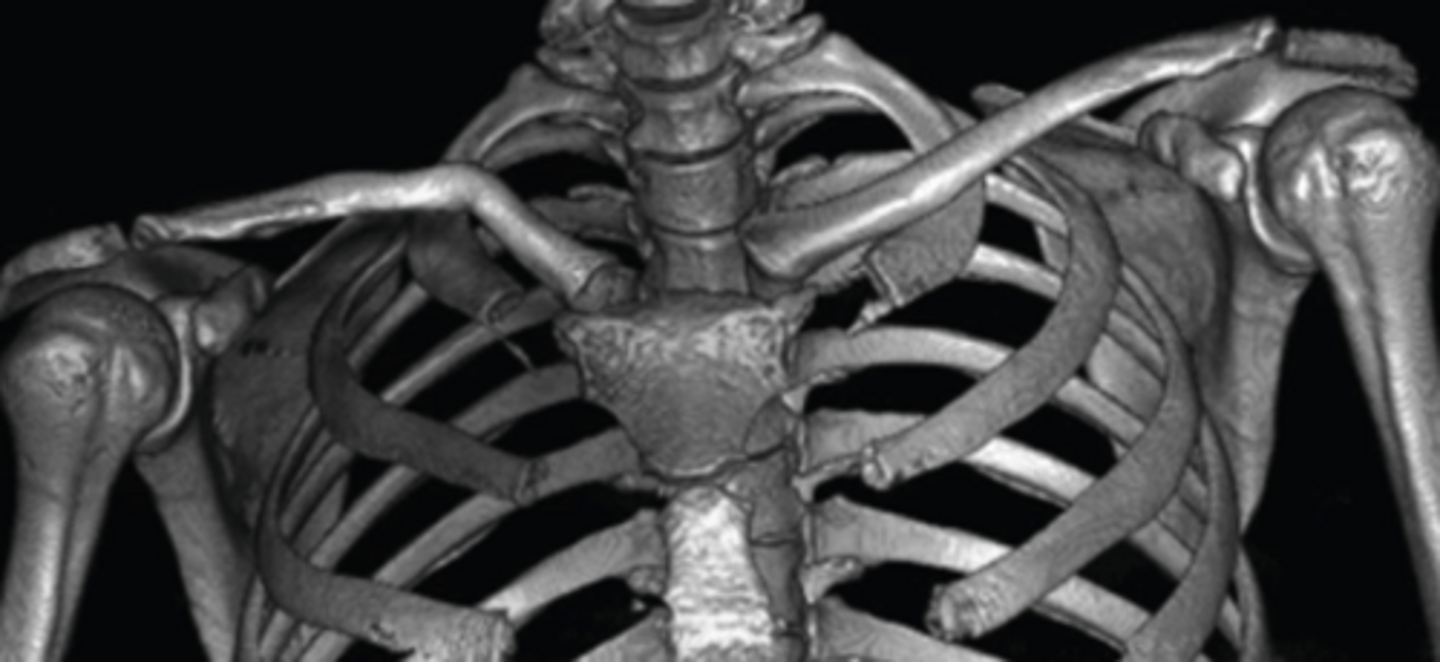 <p>Evaluate osseous space-occupying lesions, malunited fractures of ribs or clavicle, and soft tissue anatomic anomalies</p>