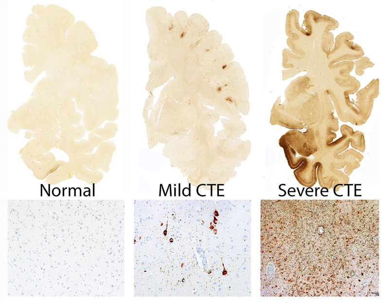 <p>CTE happens when after repeated blows to the head a protein called tau builds up in the brain and forms cell clumps. <span>These clumps of tau damage the brain cells, making them work less well and eventually causing them to die. This leads to parts of the brain shrinking over time.</span></p><p>Over time, this leads to:</p><ul><li><p class=""><strong>Brain shrinkage</strong></p></li><li><p class=""><strong>Loss of neurons</strong></p></li><li><p class=""><strong>Worsening symptoms</strong> (memory loss, mood changes, movement problems)</p></li></ul><p></p>