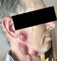 <p>a painful swollen lymph node and a symptom of the Black Death</p>