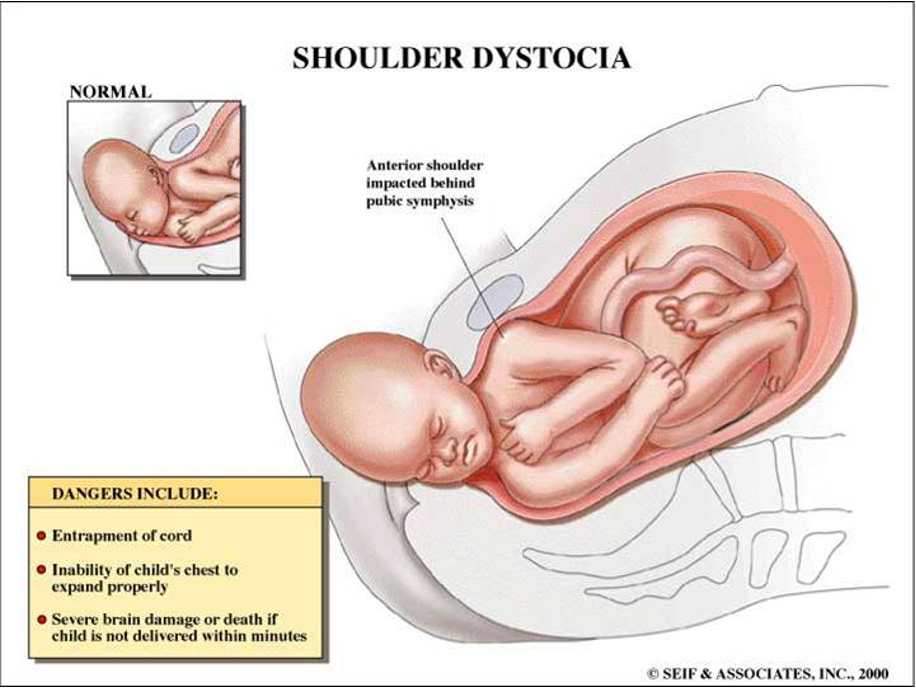 <p>Dystocia</p>