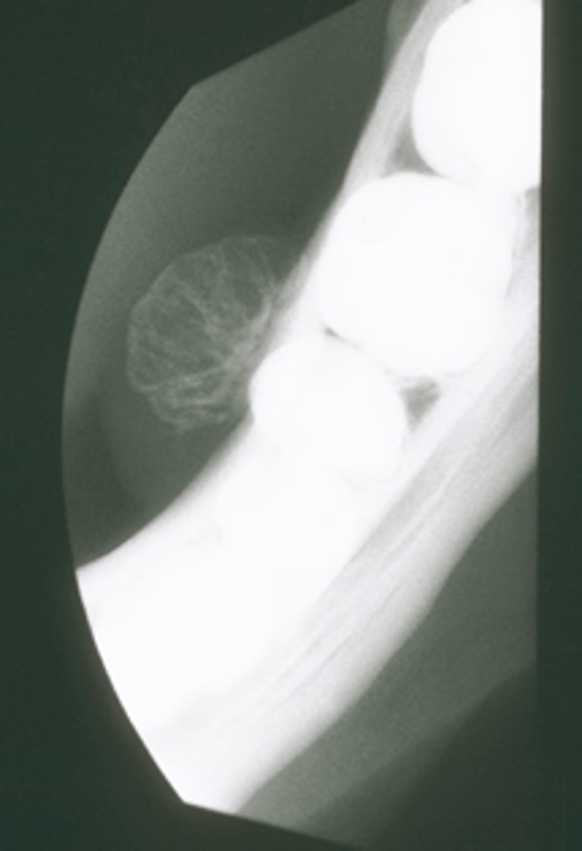 <p>ID the pathology:</p>