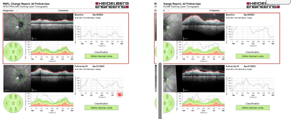 <p>optic neuritis: same ox just 17 days later </p>