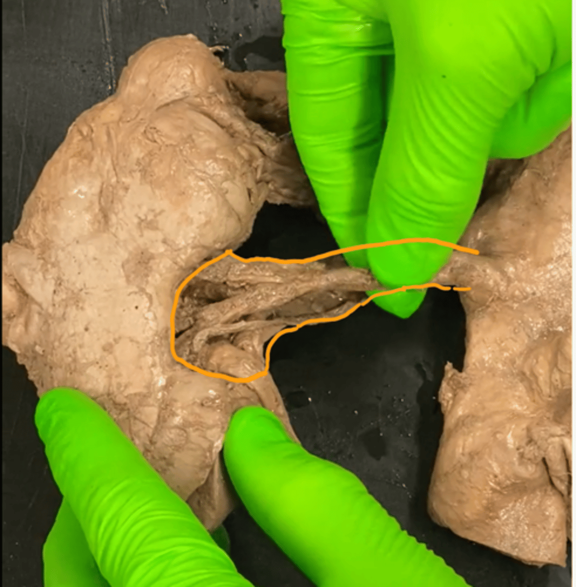 <p>anatomische term die verwijst naar een holte of een gebied waar bloedvaten, zenuwen en lymfevaten een orgaan of een deel van een orgaan binnenkomen en verlaten</p>