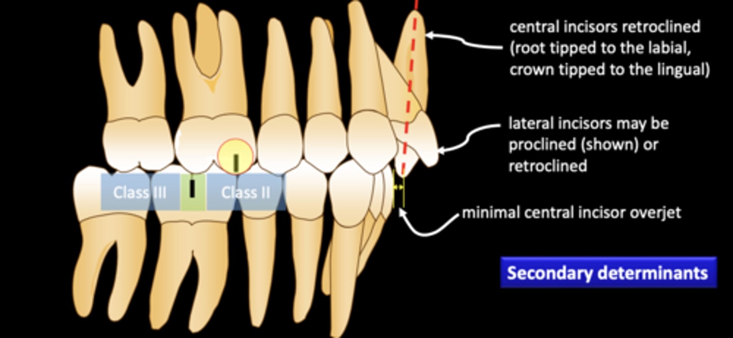 <p>- Class II Molar occlusion</p><p>- Central incisor retroclined</p><p>- Later incisors may be proclined or retroclined</p>