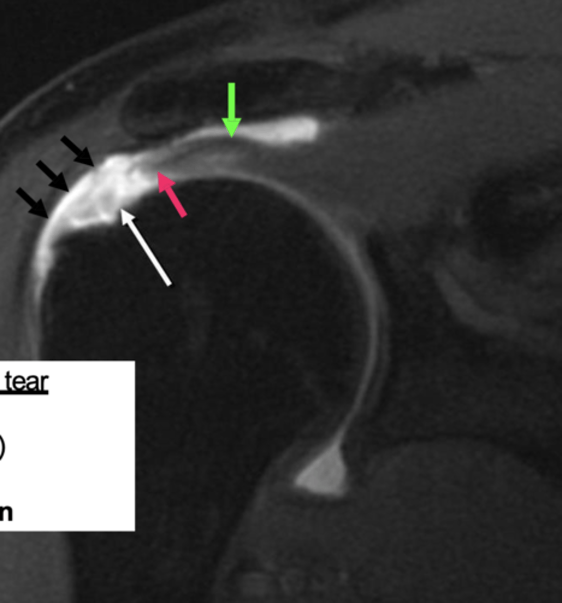 <p>What is this image depicting w/ the rotator cuff? (hint: it is a T2 image)</p>