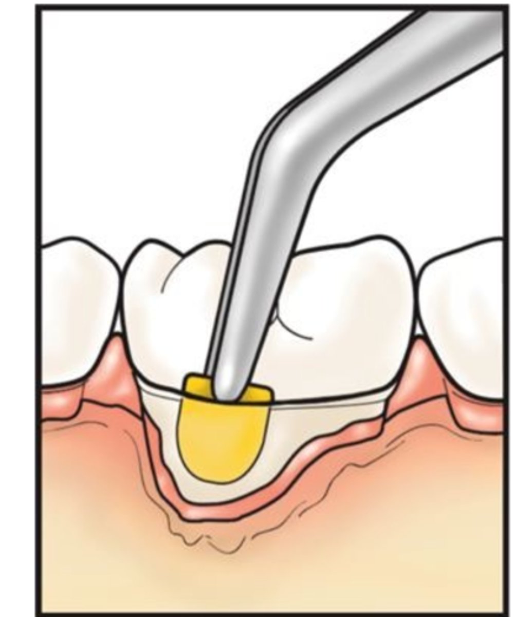 <p>controlled release mechanism -- brand name Perio Chip</p><p>• dissolves</p><p>• no risk of antibiotic resistance</p><p>• shown in studies to reduce alveolar bone loss compared to periodontal instrumentation alone</p>