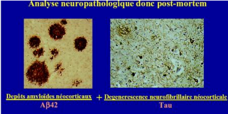 <p>Dans les études du cerveau en autopsie, on a des <span style="color: rgb(31, 95, 219);">dépôts/plaques amyloïdes néocorticaux</span> (support : protéine Aβ42) et également des <span style="color: rgb(255, 24, 24);">dégénérescences neurofibrillaires néocorticales </span>(support : protéine Tau).</p>