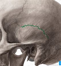 <p>What suture is this?</p>