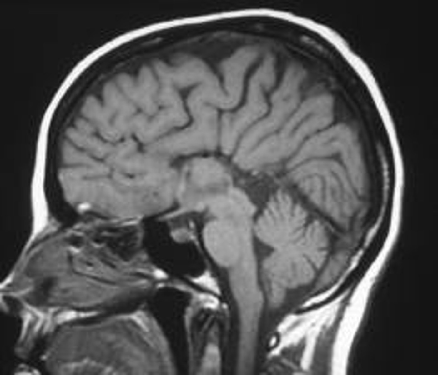 <p>Agenesis of the corpus callosum may cause what?</p>
