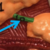 <p>The duct that carries saliva from the submandibular gland to the floor of the mouth, opening at the sublingual papilla under the tongue.</p>