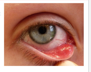 <p>chalazion</p>