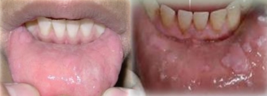 <p>Multifocal sessile papules and nodules with pink grainy/stippled surface. Lesions coalesce. Cobblestone appearance.</p><p class="has-focus">Not tender</p><p class="has-focus">First and second decades</p><p class="has-focus">No gender bias</p><p class="has-focus"><strong>Found on:</strong></p><p class="has-focus">Labial and buccal mucosa and tongue</p><p class="has-focus"></p><p class="has-focus is-empty">Ask: Family history of same condition? Living conditions? Diet? Oral hygeine habits?</p>