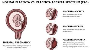 <p><strong>Retained placenta (tissue)</strong></p><ul><li><p>placenta not expelled within 30 minutes OR fragments of placenta still inside uterus</p></li><li><p>this causes excessive bleeding&nbsp;</p><ul><li><p>physical barrier to clamping</p></li><li><p>placenta tricks uterus into not clamping down</p></li></ul></li><li><p><strong>management</strong></p><ul><li><p>manual extraction by provider</p></li><li><p>dilations and curretage ( D&amp;C) as needed</p></li></ul></li></ul><img src="https://knowt-user-attachments.s3.amazonaws.com/32aa9eaf-8327-4ca2-a2a0-71e8704a0843.png" data-width="50%" data-align="center"><p><strong>placental acreta syndrome</strong></p><ul><li><p>placenta has abnormal or invasive implantation</p></li><li><p><strong>management</strong></p><ul><li><p>usually D&amp;C or hysterectomy if severe</p></li><li><p>MASSIVE PPH</p></li></ul></li></ul><p></p>
