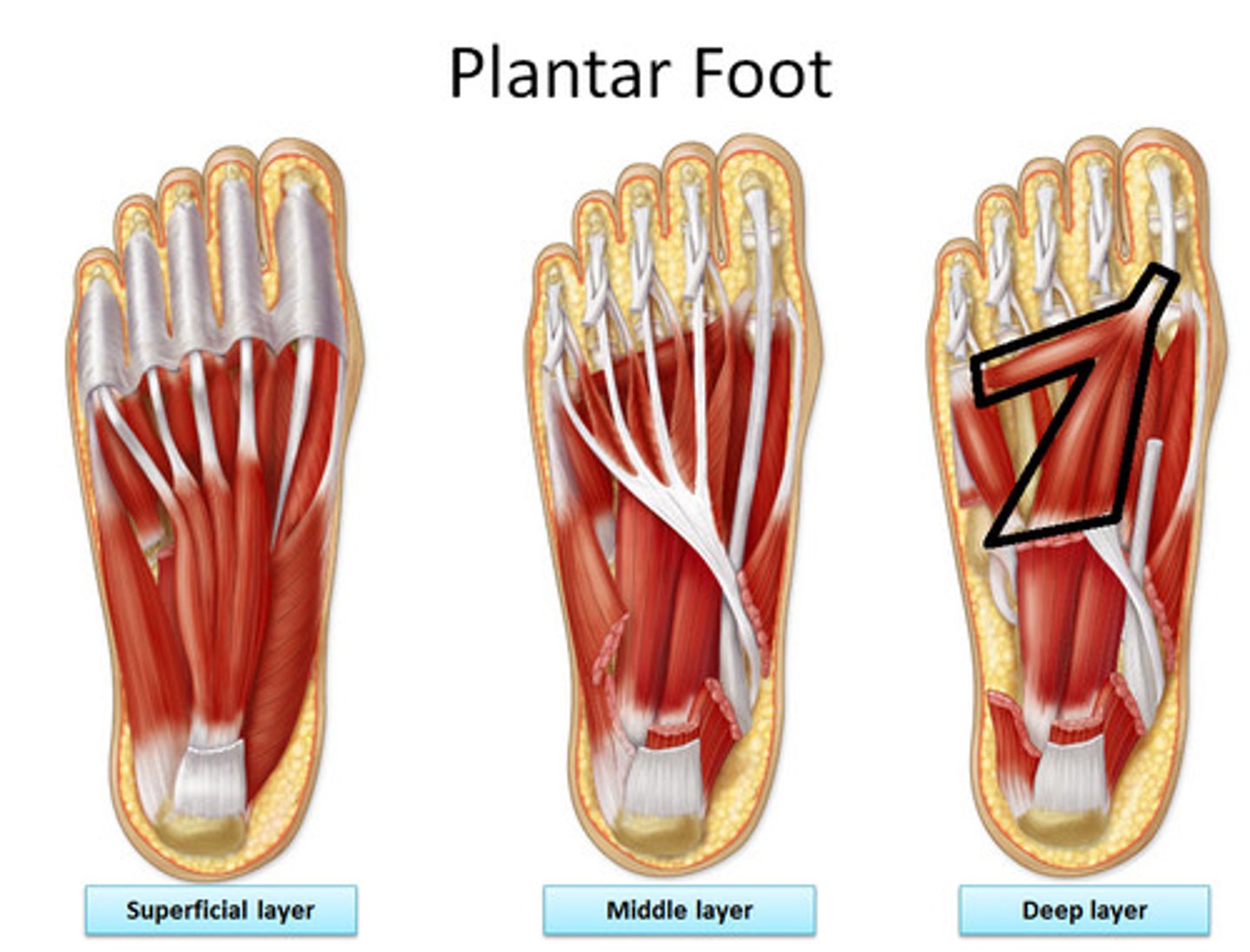 <p>Origin: oblique head from base of metatarsals 2-4; transverse head from plantar ligaments of 3rd-5th metatarsophalangeal joints</p><p>Insertion: tendons of both heads attach to lateral side of base of proximal phalanx of 1st digit</p><p>Innervation: deep branch of lateral plantar nerve (S2, <strong>S3</strong>)</p><p>Action: adducts 1st digit; assists in maintaining transverse arch of foot</p>