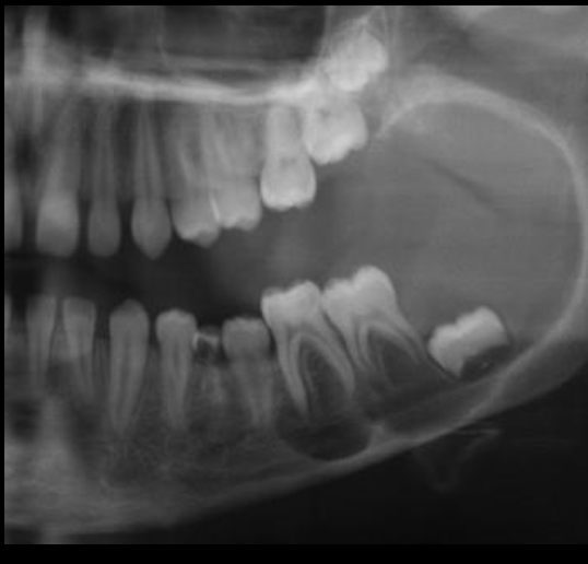 <ul><li><p>Seen in younger patients</p></li><li><p>More likely unilocular and pericoronal</p></li><li><p>More favorable clinical behavior and response to treatment</p></li><li><p>May recur after a long delay</p></li></ul><p></p>