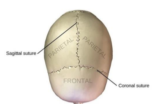 <p>Frontal to parietal bones</p>