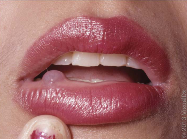 <p>mucocele characteristics </p>