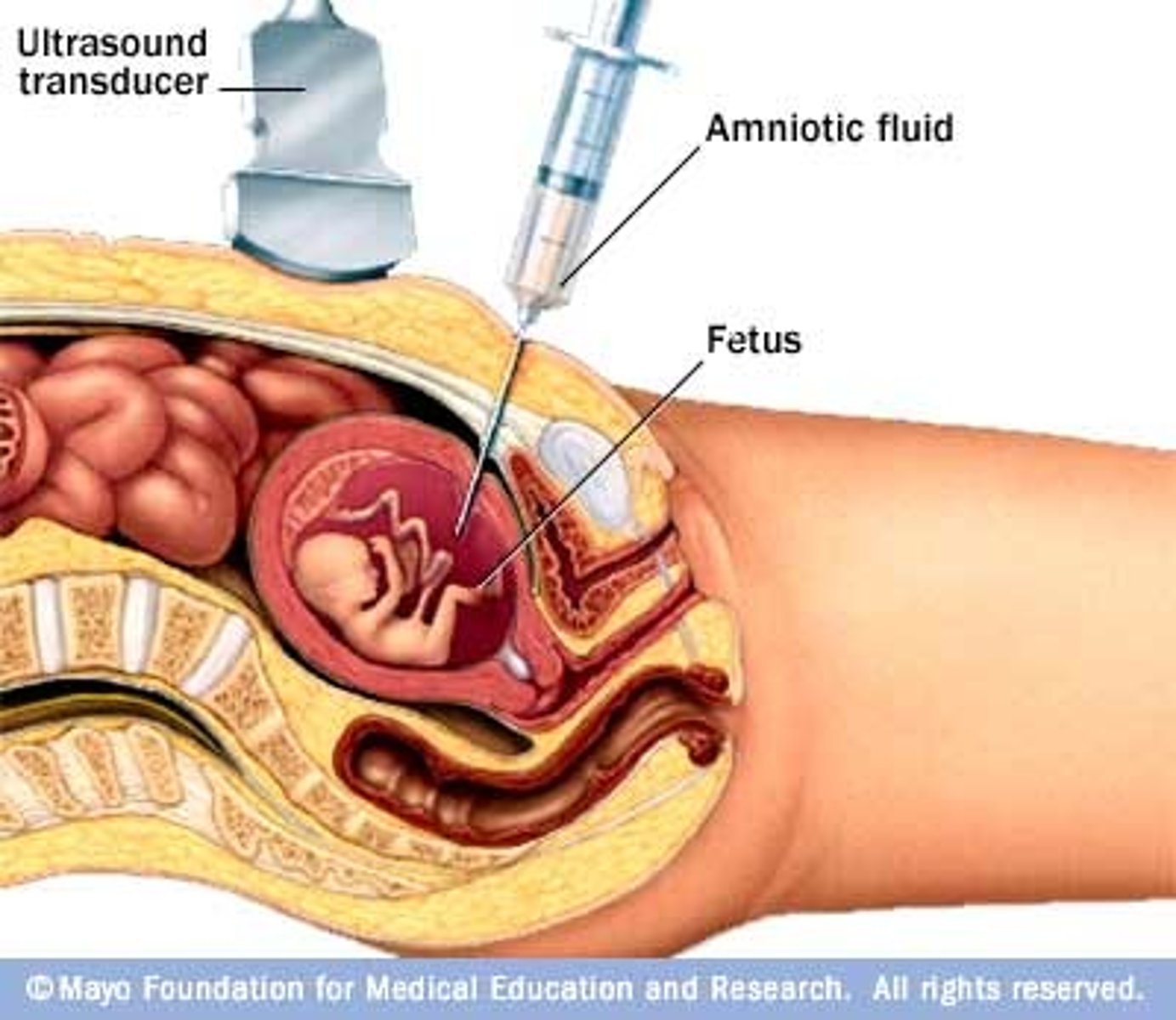 <p>An invasive procedure used to diagnose congenital disorders --&gt; a needle punctures the amniotic sac to collect fluid for analysis</p>