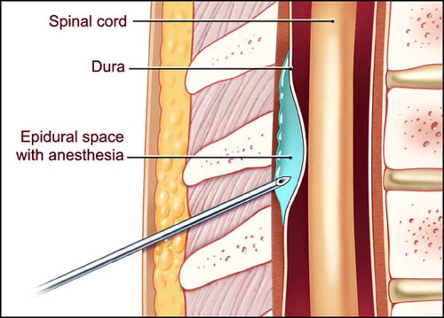 <p>The space between the dural sheath and the bone of the vertebral canal; contains loose connective tissue and adipose tissue that provides a protective pad around the spinal cord</p>