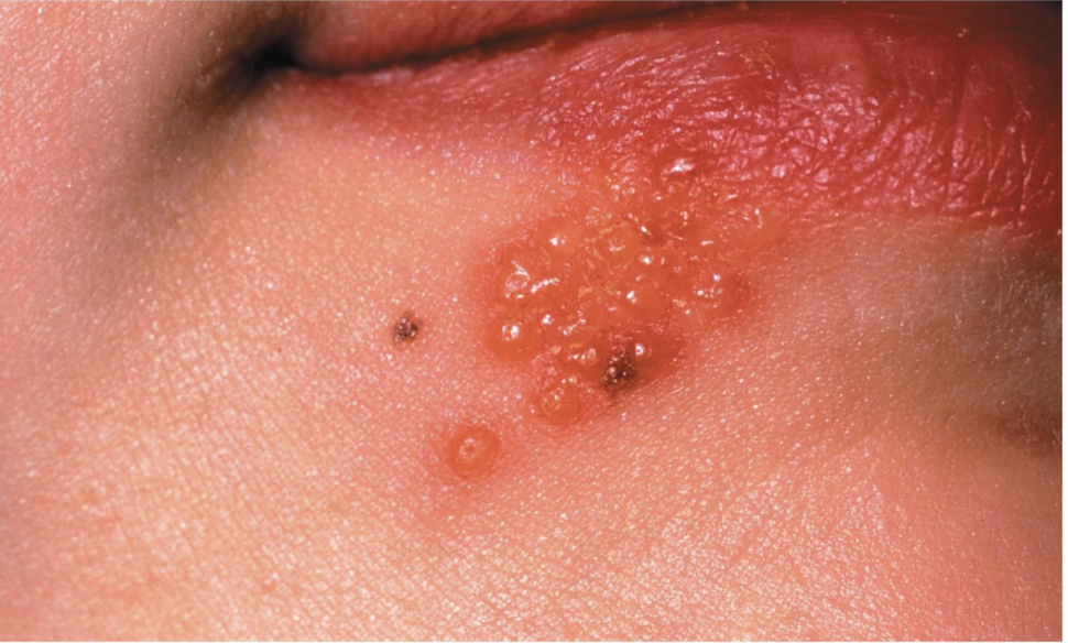 <p>this image depicts an individual who has cold sores. what<strong> type</strong>&nbsp;of microbe causes cold sores?</p>