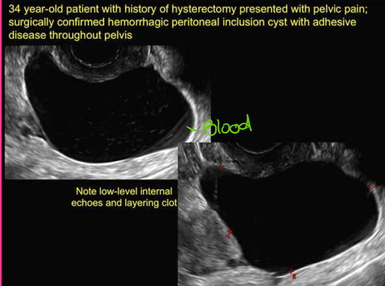 <p>Peritoneal inclusion cysts are formed when _______ trap ________ ____ around the ovaries </p>