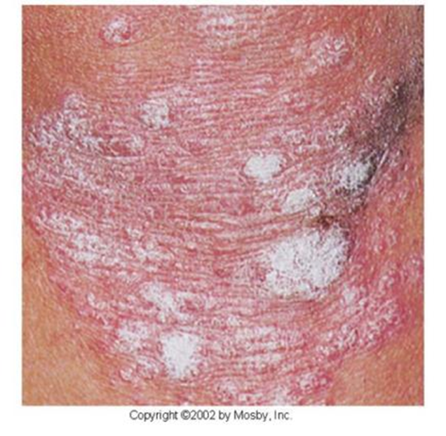 <p>Psoriasis </p>