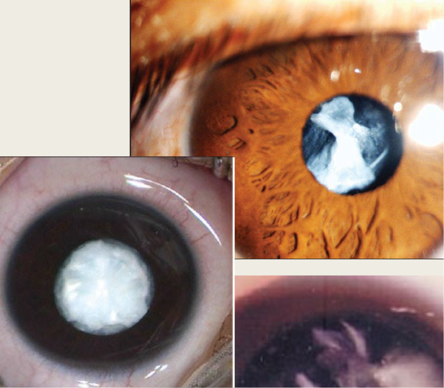 <ul><li><p>lens proteins are resorbed when leaving the anterior &amp; posterior capsule</p><ul><li><p>they fuse together and form a dense white membrane</p></li></ul></li></ul><p></p>
