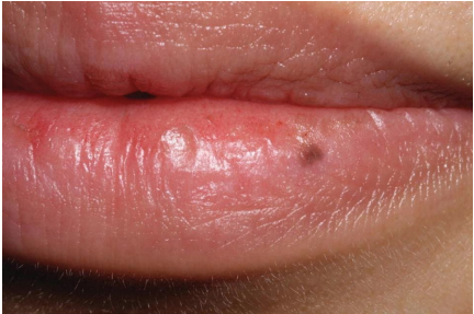<p>What lesion is this?</p>