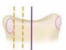 <p>pedicle disappearing</p>