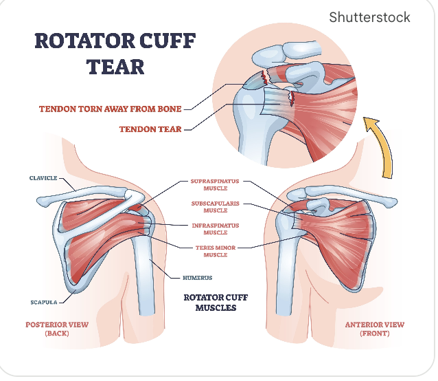 <p>What are <strong>rotator cuff tear symptoms</strong>?</p>