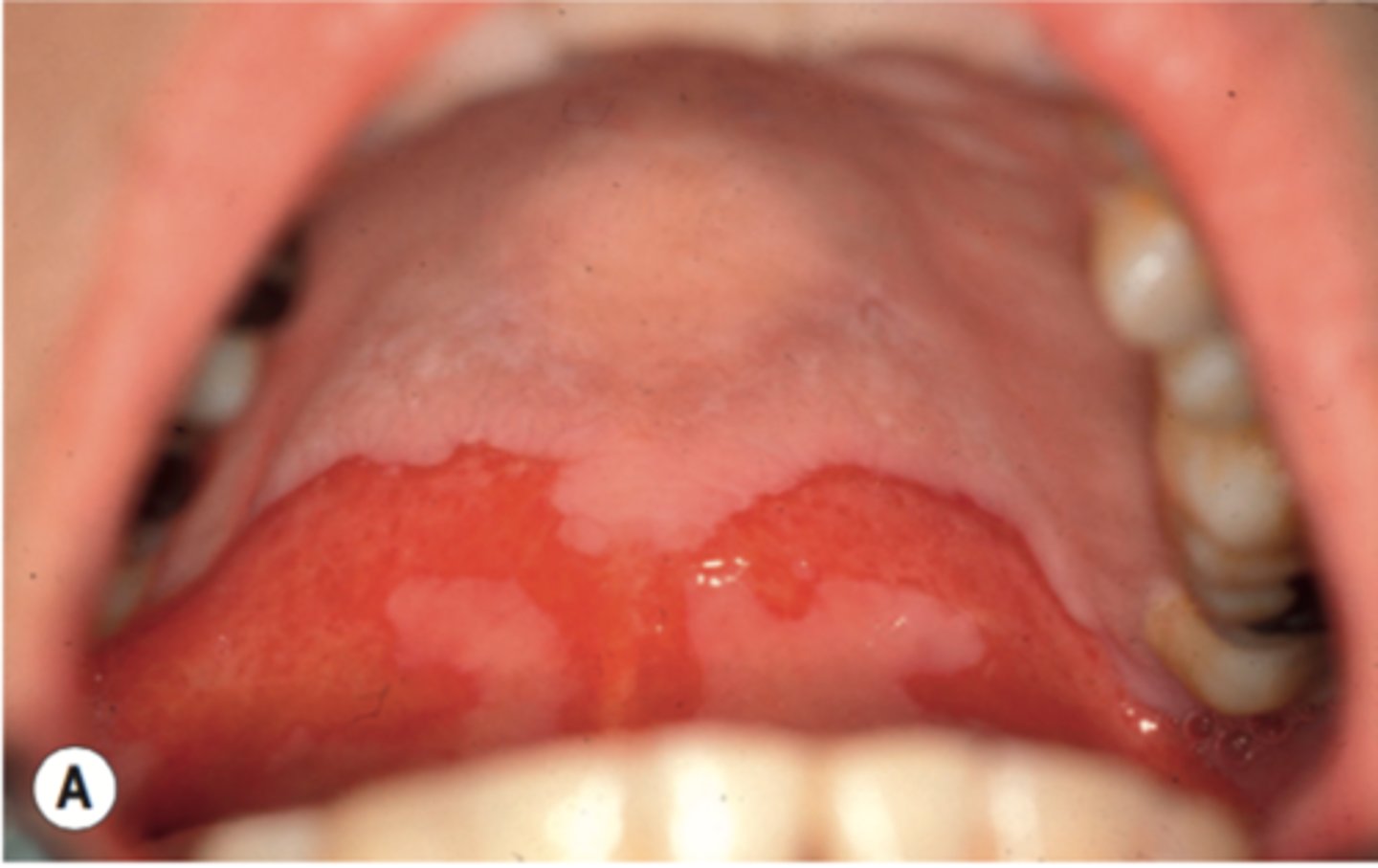 <p>inflammation of oral tissues</p><p>often seen in cancer pts</p>