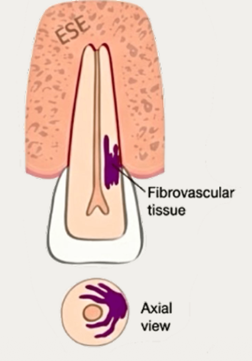 <p>Which type of resorption?</p>