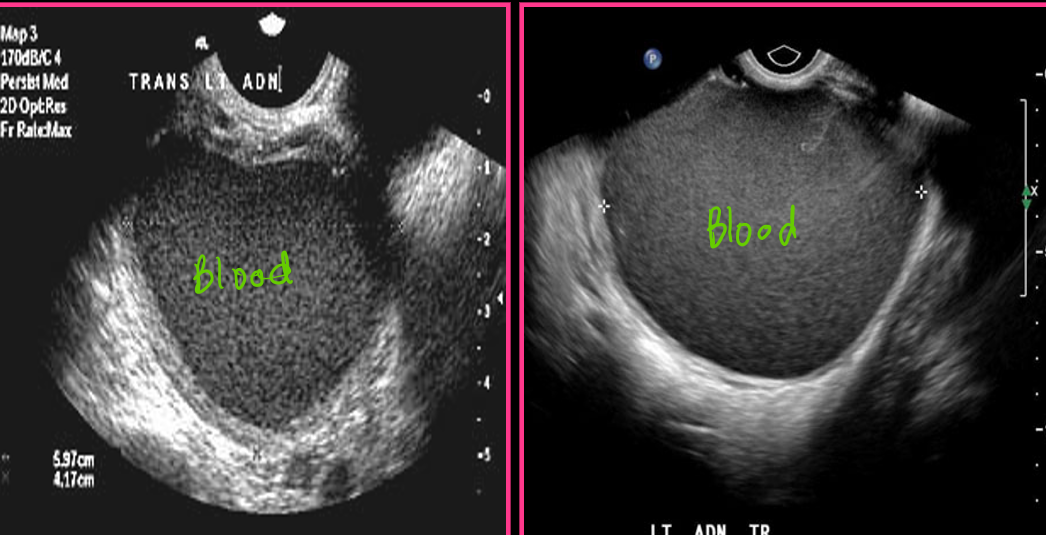 <p>Focal endometriosis consists of a mass called ________ or _______</p>