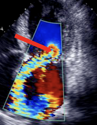 <p><span>•</span><span style="font-family: &quot;Arial Narrow&quot;">The __________ is the area of increased flow velocity before the regurgitant orifice.</span></p><p><span>•</span><span style="font-family: &quot;Arial Narrow&quot;">The size of this region corresponds to the magnitude of blood flow and the size of the regurgitant orifice.</span></p>