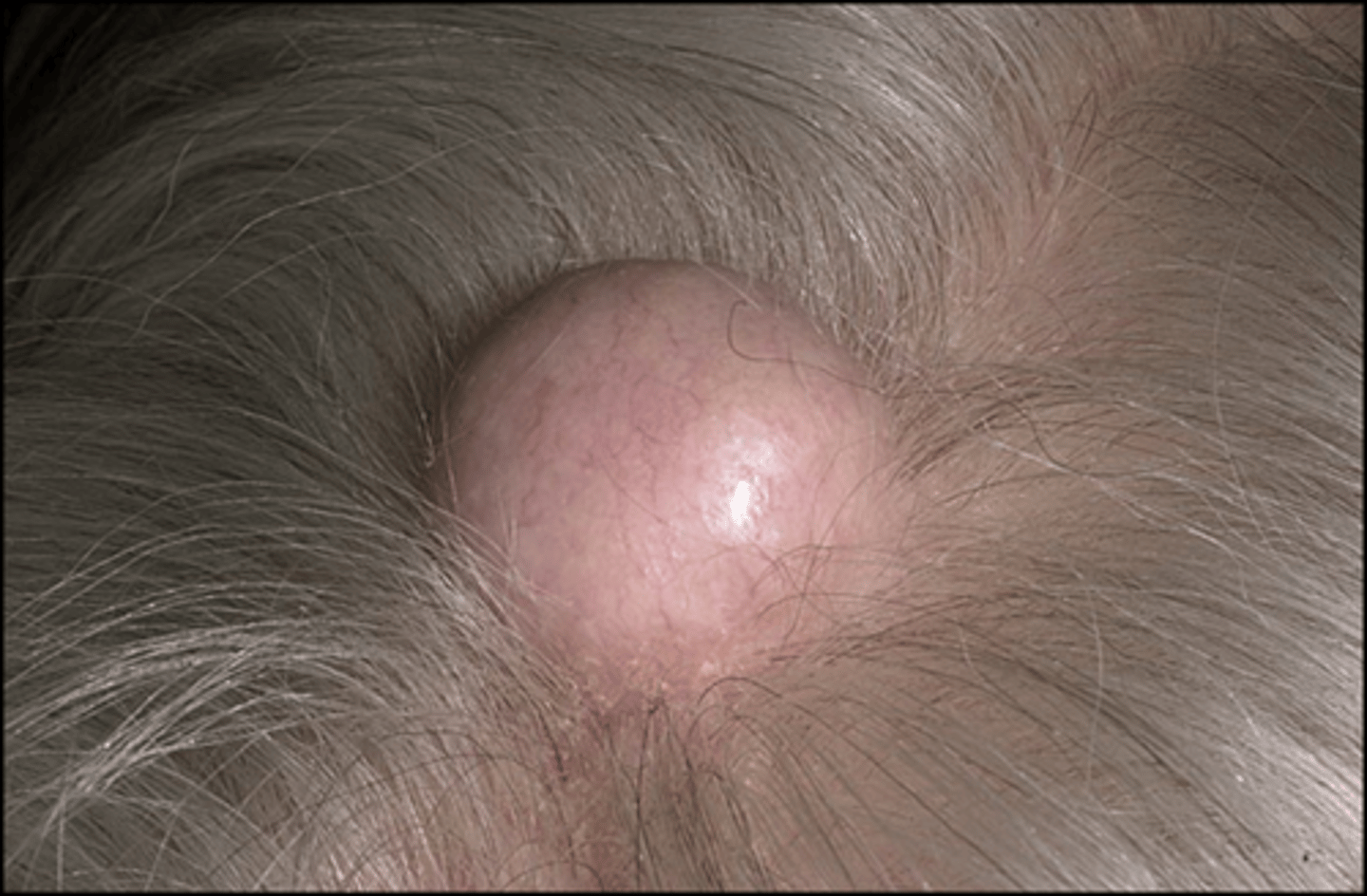 <p>diagnose this:</p><p>Epidermoid cyst of the scalp, arises from hair follicle</p>