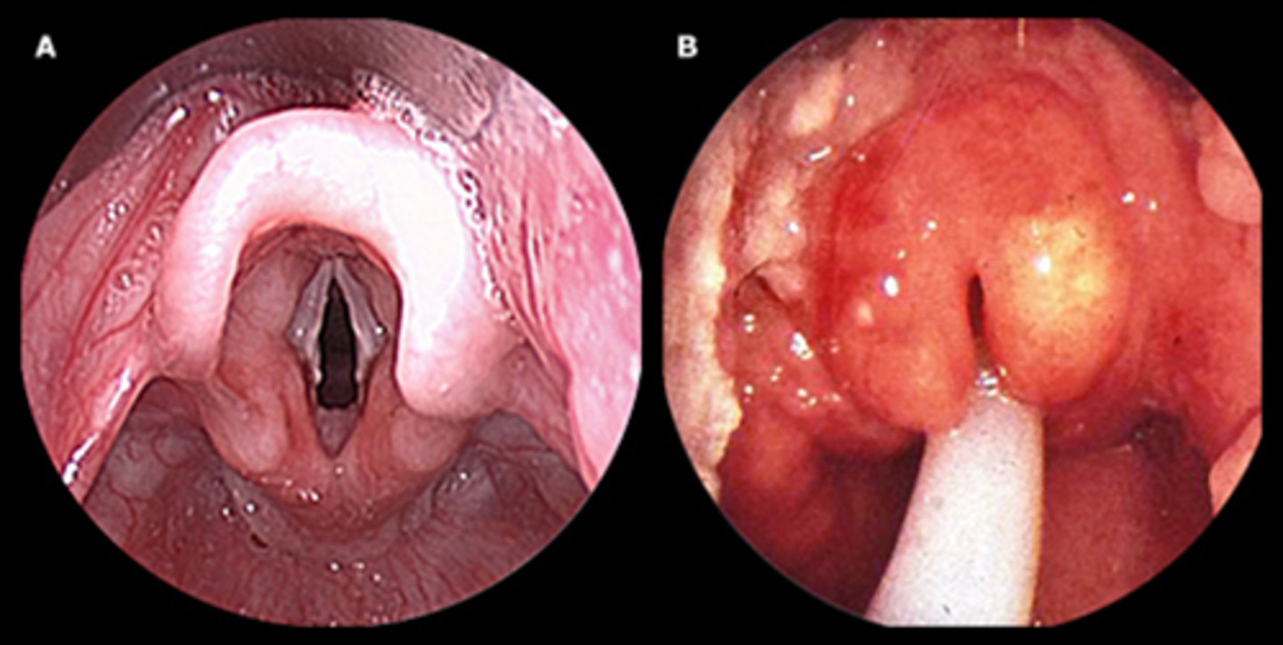 <p>1. the epiglottis becomes inflamed and swollen</p><p>2. swelling pushes down and blocks the trachea (windpipe)</p><p>3. this causes airway obstruction=NO BUENO because it causes trouble breathing</p><p>4. the body struggles for oxygen leading to cyanosis and pallor</p>