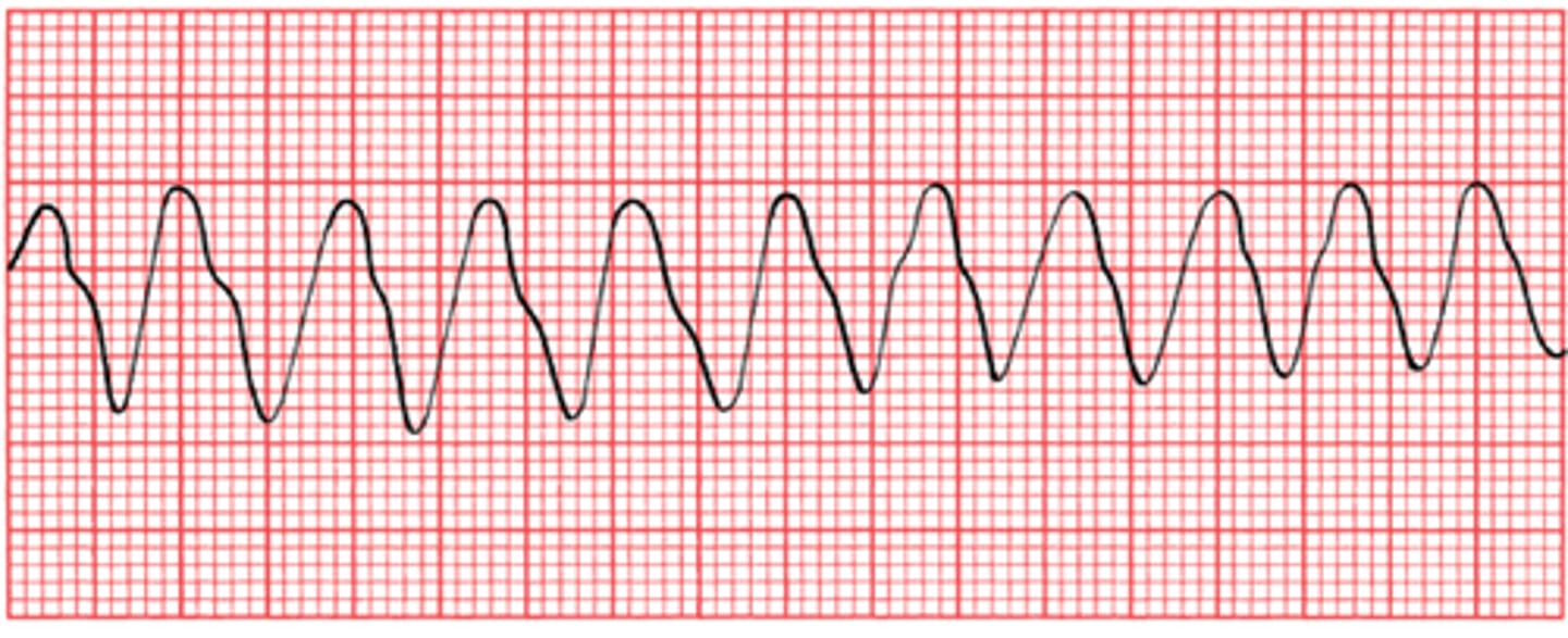 <p>Rate usually above 100 bpm. rhythm usually regular. no P wave or it appears after QRS complex with retrograde conduction. requires immediate medical attention. common causes: post MI, rheumatic heart disease, CAD and cardiomyopathy</p>